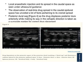 • Local anaesthetic injection and its spread in the caudal space as
seen under ultrasound guidance
• The observation of real-time drug spread in the caudal epidural
space has unveiled a lot of facts pertaining to its cranial spread
• Posterior dural sag [Figure 4] as the drug displaces posterior dura
anteriorly while making its way in the cehaplic direction is taken as
a surrogate marker for correct drug placement.
 