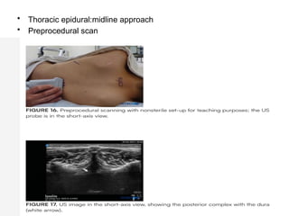 • Thoracic epidural:midline approach
• Preprocedural scan
 