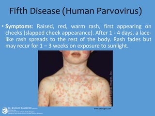 Fifth Disease (Human Parvovirus)
• Symptoms: Raised, red, warm rash, first appearing on
cheeks (slapped cheek appearance). After 1 - 4 days, a lace-
like rash spreads to the rest of the body. Rash fades but
may recur for 1 – 3 weeks on exposure to sunlight.
www.skinsight.com
 