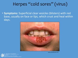 Herpes “cold sores” (virus)
• Symptoms: Superficial clear vesicles (blisters) with red
base, usually on face or lips, which crust and heal within
days.
www.activeforever.com
 
