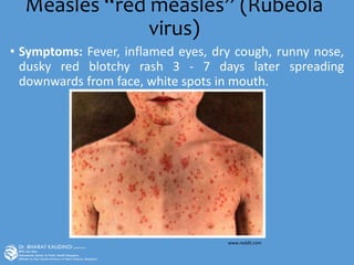 Measles “red measles” (Rubeola
virus)
• Symptoms: Fever, inflamed eyes, dry cough, runny nose,
dusky red blotchy rash 3 - 7 days later spreading
downwards from face, white spots in mouth.
www.reddit.com
 