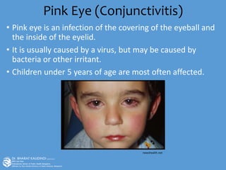Pink Eye (Conjunctivitis)
• Pink eye is an infection of the covering of the eyeball and
the inside of the eyelid.
• It is usually caused by a virus, but may be caused by
bacteria or other irritant.
• Children under 5 years of age are most often affected.
newshealth.net
 