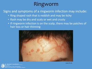 Ringworm
Signs and symptoms of a ringworm infection may include:
• Ring shaped rash that is reddish and may be itchy
• Rash may be dry and scaly or wet and crusty
• If ringworm infection is on the scalp, there may be patches of
hair loss or hair thinning
www.nhs.uk
 