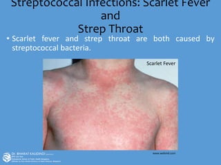 Streptococcal Infections: Scarlet Fever
and
Strep Throat
• Scarlet fever and strep throat are both caused by
streptococcal bacteria.
www.webmd.com
Scarlet Fever
 