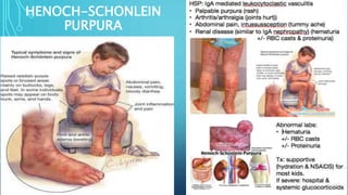HENOCH-SCHONLEIN
PURPURA
 