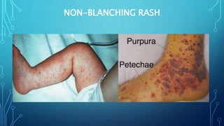 NON-BLANCHING RASH
 