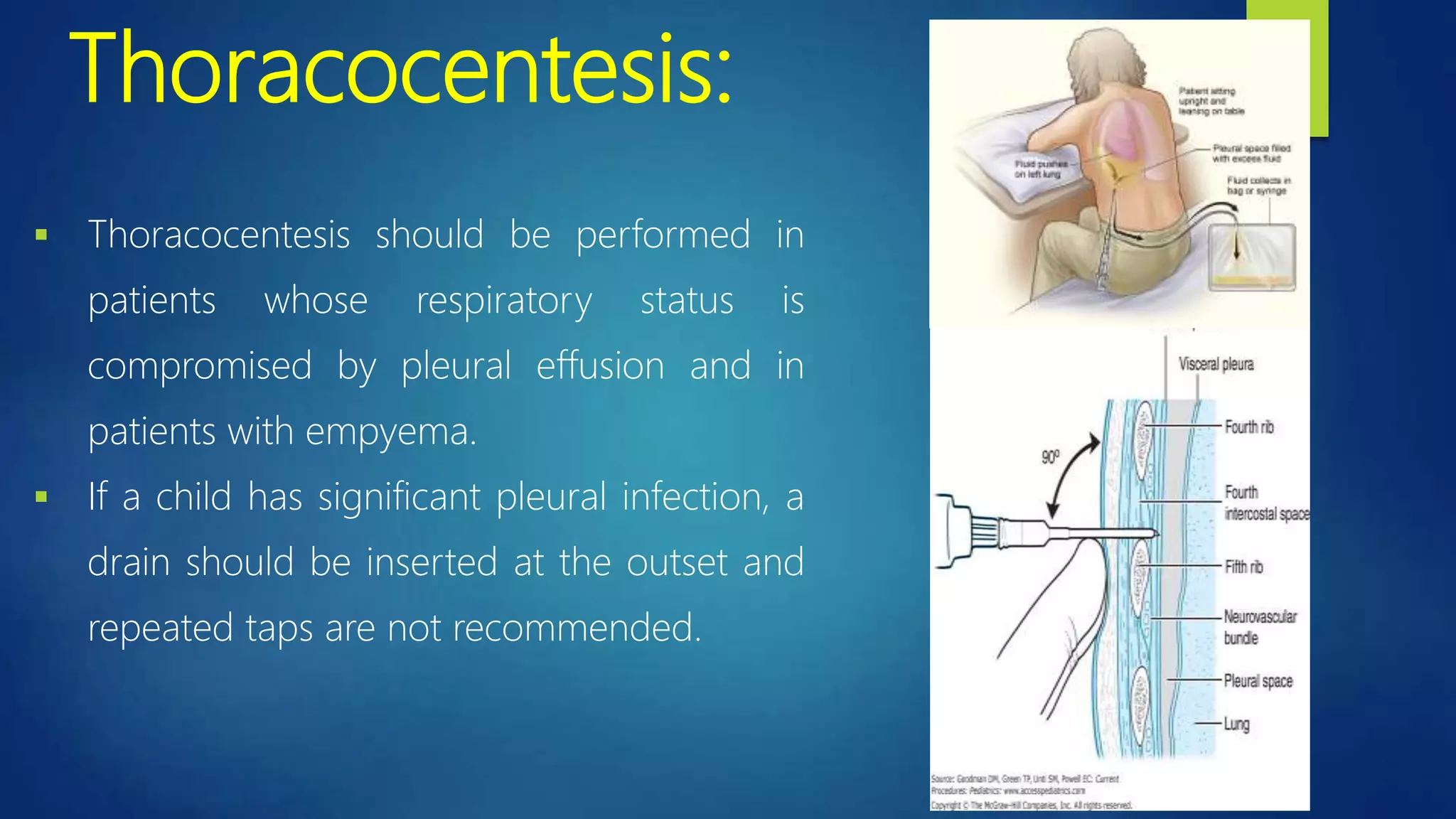 Thoracocentesis:
 Thoracocentesis should be performed in
patients whose respiratory status is
compromised by pleural effusion and in
patients with empyema.
 If a child has significant pleural infection, a
drain should be inserted at the outset and
repeated taps are not recommended.
 