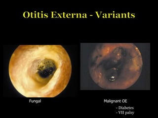 Fungal Malignant OE
- Diabetes
- VII palsy
 
