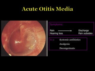 Rx : Systemic antibiotics
Analgesia
Decongestants
Symptoms:
Pain Discharge
Hearing loss Pain subsides
 