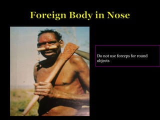 Do not use forceps for round
objects
 