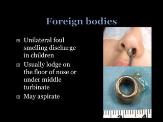  Unilateral foul
smelling discharge
in children
 Usually lodge on
the floor of nose or
under middle
turbinate
 May aspirate
 