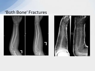 ‘Both Bone’ Fractures
 