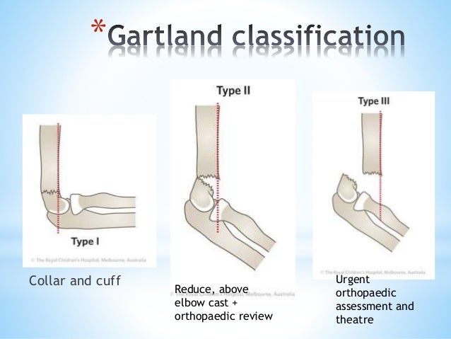 Paediatric Fractures