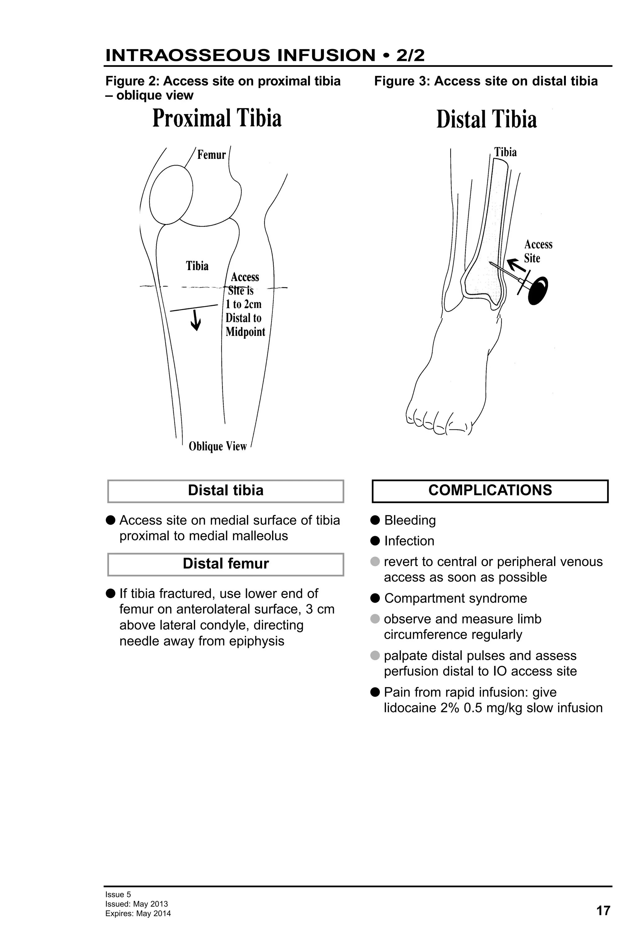 G Access site on medial surface of tibia
proximal to medial malleolus
G If tibia fractured, use lower end of
femur on anterolateral surface, 3 cm
above lateral condyle, directing
needle away from epiphysis
G Bleeding
G Infection
G revert to central or peripheral venous
access as soon as possible
G Compartment syndrome
G observe and measure limb
circumference regularly
G palpate distal pulses and assess
perfusion distal to IO access site
G Pain from rapid infusion: give
lidocaine 2% 0.5 mg/kg slow infusion
COMPLICATIONS
Distal femur
Distal tibia
17
Issue 5
Issued: May 2013
Expires: May 2014
INTRAOSSEOUS INFUSION • 2/2
Figure 2: Access site on proximal tibia
– oblique view
Figure 3: Access site on distal tibia
 