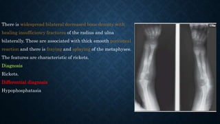 Table Rickets Differential Paediatric imaging rapid review of radiology | PPTX