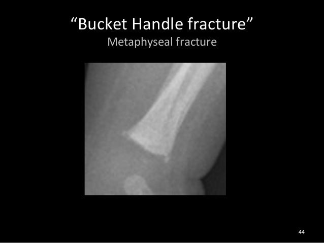 Paediatric Fractures For SCH ED