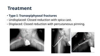 Treatment
• Type I: Transepiphyseal fractures
- Undisplaced: Closed reduction with spica cast.
- Displaced: Closed reduction with percutaneous pinning.
 