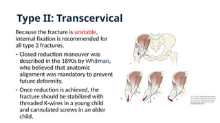 Type II: Transcervical
Because the fracture is unstable,
internal fixation is recommended for
all type 2 fractures.
- Closed reduction maneuver was
described in the 1890s by Whitman,
who believed that anatomic
alignment was mandatory to prevent
future deformity.
- Once reduction is achieved, the
fracture should be stabilized with
threaded K-wires in a young child
and cannulated screws in an older
child.
 