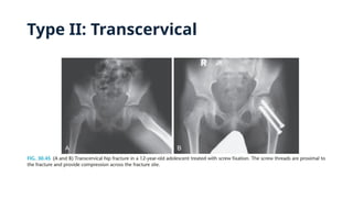 Type II: Transcervical
 