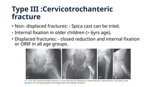 Type III :Cervicotrochanteric
fracture
• Non- displaced fractures: - Spica cast can be tried.
- Internal fixation in older children (> 6yrs age).
• Displaced fractures: - closed reduction and internal fixation
or ORIF in all age groups.
 