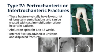 Type IV: Pertrochanteric or
Intertrochanteric Fractures
• These fracture typically have lowest risk
of long-term complications and can be
treated with cast immobilization alone
in certain patients.
• Abduction spica for 6 to 12 weeks.
• Internal fixation advised in unstable
and displaced fractures.
 