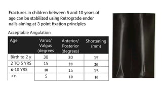 Fractures in children between 5 and 10 years of
age can be stabilized using Retrograde ender
nails aiming at 3 point fixation principles
 