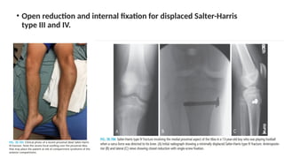 • Open reduction and internal fixation for displaced Salter-Harris
type III and IV.
 