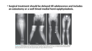 • Surgical treatment should be delayed till adolescence and includes
an osteotomy or a well timed medial hemi-epiphysiodesis.
 