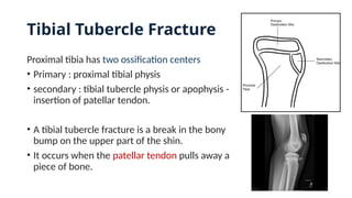 Tibial Tubercle Fracture
Proximal tibia has two ossification centers
• Primary : proximal tibial physis
• secondary : tibial tubercle physis or apophysis -
insertion of patellar tendon.
• A tibial tubercle fracture is a break in the bony
bump on the upper part of the shin.
• It occurs when the patellar tendon pulls away a
piece of bone.
 