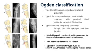 Ogden classification
• Subdivides each type into A and B to account for
degree of displacement and comminution.
• Non operative treatment for Type IA
• Operative treatment for Type IB, II, III
- Smooth pins, threaded steinman pins, Tension bands
 