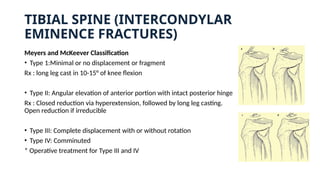 TIBIAL SPINE (INTERCONDYLAR
EMINENCE FRACTURES)
Meyers and McKeever Classification
• Type 1:Minimal or no displacement or fragment
Rx : long leg cast in 10-15° of knee flexion
• Type II: Angular elevation of anterior portion with intact posterior hinge
Rx : Closed reduction via hyperextension, followed by long leg casting.
Open reduction if irreducible
• Type III: Complete displacement with or without rotation
• Type IV: Comminuted
* Operative treatment for Type III and IV
 