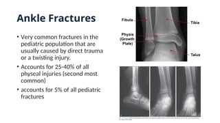 Ankle Fractures
• Very common fractures in the
pediatric population that are
usually caused by direct trauma
or a twisting injury.
• Accounts for 25-40% of all
physeal injuries (second most
common)
• accounts for 5% of all pediatric
fractures
 