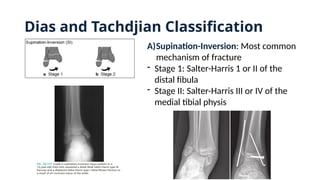 Dias and Tachdjian Classification
A)Supination-Inversion: Most common
mechanism of fracture
- Stage 1: Salter-Harris 1 or II of the
distal fibula
- Stage II: Salter-Harris III or IV of the
medial tibial physis
 