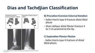 B) Pronation-Eversion-External Rotation
- Salter-Harris type II fracture distal tibial
physis
- Short oblique distal fibular fracture 4
to 7 cm proximal to the tip.
C) Supination Plantar Flexion
- Salter-Harris type II fracture of distal
tibial physis.
Dias and Tachdjian Classification
 