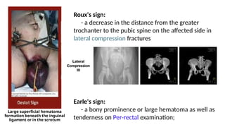 Large superficial hematoma
formation beneath the inguinal
ligament or in the scrotum
Roux's sign:
- a decrease in the distance from the greater
trochanter to the pubic spine on the affected side in
lateral compression fractures
Earle's sign:
- a bony prominence or large hematoma as well as
tenderness on Per-rectal examination;
 
