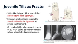Juvenile Tillaux Fractures
• Salter-Harris type III fracture of the
anterolateral tibial epiphysis.
• External rotation force causes the
anterior tibiofibular ligament to
avulse the fragment.
• Occurs in children between the ages
of 12 to 14 years; 18-month window
where lateral physis remains open.
 
