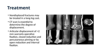 Treatment
• Nondisplaced fractures may
be treated in a long-leg cast.
• CT scan is essential to
determine the degree of
displacement.
• Articular displacement of >2
mm warrants operative
fixation, closed reduction and
percutaneous pinning or by
open reduction and internal
fixation.
 