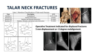 TALAR NECK FRACTURES
Operative Treatment Indicated for displaced fractures
5 mm displacement or >5 degree malalignment.
 