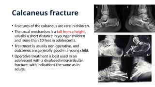 Calcaneus fracture
• Fractures of the calcaneus are rare in children.
• The usual mechanism is a fall from a height,
usually a short distance in younger children
and more than 10 feet in adolescents.
• Treatment is usually non-operative, and
outcomes are generally good in a young child.
• Operative treatment is best used in an
adolescent with a displaced intra-articular
fracture, with indications the same as in
adults.
 