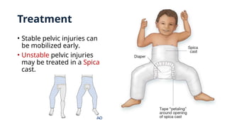 Treatment
• Stable pelvic injuries can
be mobilized early.
• Unstable pelvic injuries
may be treated in a Spica
cast.
 