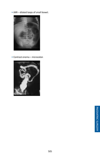 505
• AXR – dilated loops of small bowel.
• Contrast enema – microcolon
PAEDIATRICSURGERY
 