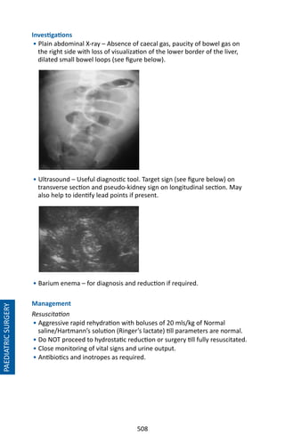 508
Investigations
• Plain abdominal X-ray – Absence of caecal gas, paucity of bowel gas on
the right side with loss of visualization of the lower border of the liver,
dilated small bowel loops (see figure below).
• Ultrasound – Useful diagnostic tool. Target sign (see figure below) on
transverse section and pseudo-kidney sign on longitudinal section. May
also help to identify lead points if present.
• Barium enema – for diagnosis and reduction if required.
Management
Resuscitation
• Aggressive rapid rehydration with boluses of 20 mls/kg of Normal
saline/Hartmann’s solution (Ringer’s lactate) till parameters are normal.
• Do NOT proceed to hydrostatic reduction or surgery till fully resuscitated.
• Close monitoring of vital signs and urine output.
• Antibiotics and inotropes as required.
PAEDIATRICSURGERY
 