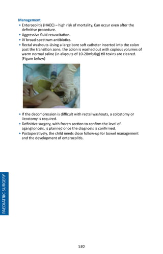 530
Management
• Enterocolitis (HAEC) – high risk of mortality. Can occur even after the
definitive procedure.
• Aggressive fluid resuscitation.
• IV broad-spectrum antibiotics.
• Rectal washouts-Using a large bore soft catheter inserted into the colon
past the transition zone, the colon is washed out with copious volumes of
warm normal saline (in aliqouts of 10-20mls/kg) till toxins are cleared.
(Figure below)
• If the decompression is difficult with rectal washouts, a colostomy or
ileostomy is required.
• Definitive surgery, with frozen section to confirm the level of
aganglionosis, is planned once the diagnosis is confirmed.
• Postoperatively, the child needs close follow-up for bowel management
and the development of enterocolitis.
PAEDIATRICSURGERY
 
