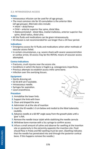 578
2.3. INTRAOSSEOUS ACCESS
Notes:
• Intraosseous infusion can be used for all age groups.
• The most common site for IO cannulation is the anterior tibia
(all age groups). Alternate sites include:
• Infant – distal femur
• Child – anterior superior iliac spine, distal tibia.
• Adolescent/adult - distal tibia, medial malleolus, anterior superior iliac
spine, distal radius, distal ulna.
• All the fluids and medications can be given intraosseously.
• IO infusion is not recommended for use longer than a 24 hour period.
Indications
• Emergency access for IV fluids and medications when other methods of
vascular access failed.
• In certain circumstances, e.g. severe shock with severe vasoconstriction
or cardiac arrest, IO access may be the INITIAL means of vascular access
attempted.
Contra-indications
• Fractures, crush injuries near the access site.
• Conditions in which the bone is fragile e.g. osteogenesis imperfecta.
• Previous attempts to establish access inthe same bone.
• Infection over the overlying tissues.
Equipment
• Sterile dressing set.
• EZ-IO drill set if available.
• Intraosseous needle.
• Syringes for aspiration.
• Local anaesthesia.
Procedure
1. Immobilize the lower limb.
2. Support the limb with linen
3. Clean and draped the area
4. Administer LA at the site of insertion
5. Insert the IO needle 1-3 cm below and medial to the tibial tuberosity
caudally.
6. Advance needle at a 60-90o angle away from the growth plate until a
‘give’ is felt.
7. Remove the needle trocar stylet while stabilizing the needle cannula
8. Withdraw bone marrow with a 5cc syringe to confirm access
9. Infuse a small amount of saline and observe for swelling at the insertion
site or posteriorly in the extremity opposite the insertion site. Fluid
should flow in freely and NO swelling must be seen. (Swelling indicates
that the needle has penetrated into and through the posterior cortical
bone. If this happens remove the needle.)
PROCEDURES
 