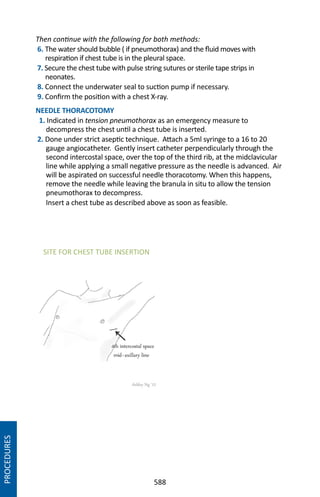 588
Then continue with the following for both methods:
6. The water should bubble ( if pneumothorax) and the fluid moves with
respiration if chest tube is in the pleural space.
7. Secure the chest tube with pulse string sutures or sterile tape strips in
neonates.
8. Connect the underwater seal to suction pump if necessary.
9. Confirm the position with a chest X-ray.
NEEDLE THORACOTOMY
1. Indicated in tension pneumothorax as an emergency measure to
decompress the chest until a chest tube is inserted.
2. Done under strict aseptic technique. Attach a 5ml syringe to a 16 to 20
gauge angiocatheter. Gently insert catheter perpendicularly through the
second intercostal space, over the top of the third rib, at the midclavicular
line while applying a small negative pressure as the needle is advanced. Air
will be aspirated on successful needle thoracotomy. When this happens,
remove the needle while leaving the branula in situ to allow the tension
pneumothorax to decompress.
Insert a chest tube as described above as soon as feasible.
PROCEDURES
SITE FOR CHEST TUBE INSERTION
 