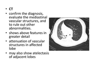 • CT
• confirm the diagnosis,
evaluate the mediastinal
vascular structures, and
to rule out other
abnormalities.
• shows above features in
greater detail
• attenuation of vascular
structures in affected
lobe
• may also show atelectasis
of adjacent lobes
 