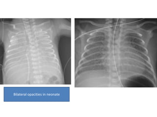 Bilateral opacities in neonate
 