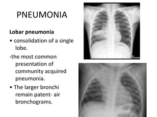 PNEUMONIA
Lobar pneumonia
• consolidation of a single
lobe.
-the most common
presentation of
community acquired
pneumonia.
• The larger bronchi
remain patent- air
bronchograms.
 