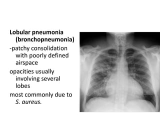 Lobular pneumonia
(bronchopneumonia)
-patchy consolidation
with poorly defined
airspace
opacities usually
involving several
lobes
most commonly due to
S. aureus.
 