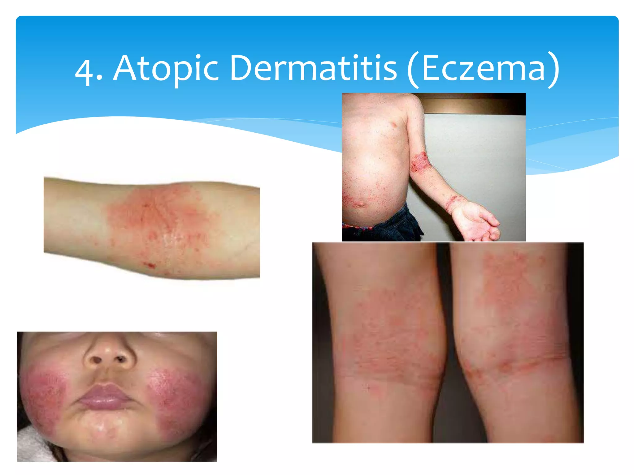 Paediatric rashes | PPTX